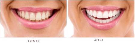 denta-vive-before-after-result-smile-fresh